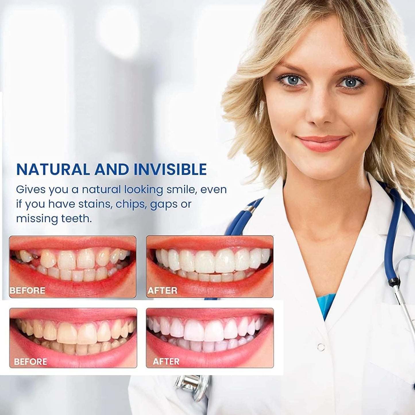 Snap-On Smile Teeth | ابتسامة سناب أون للأسنان
